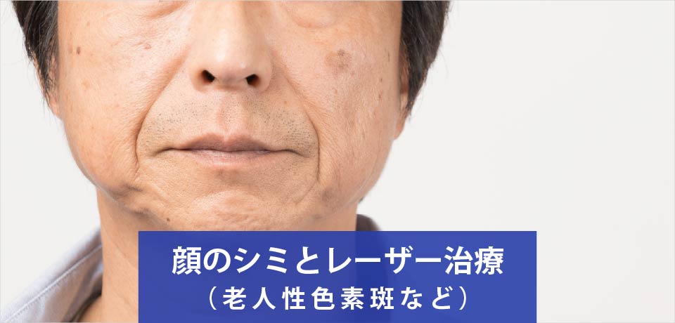 顔のシミとレーザー治療（老人性色素斑など）