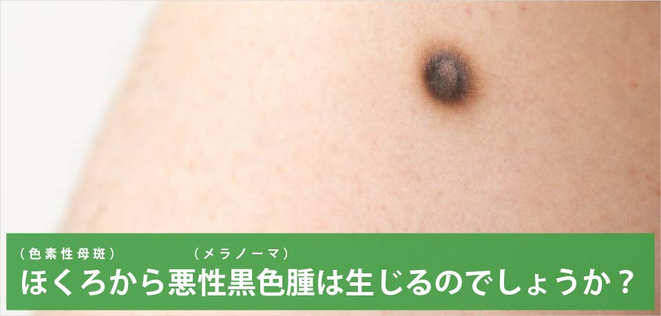 ほくろ（色素性母斑）から（メラノーマ）悪性黒色腫は生じるのでしょうか？