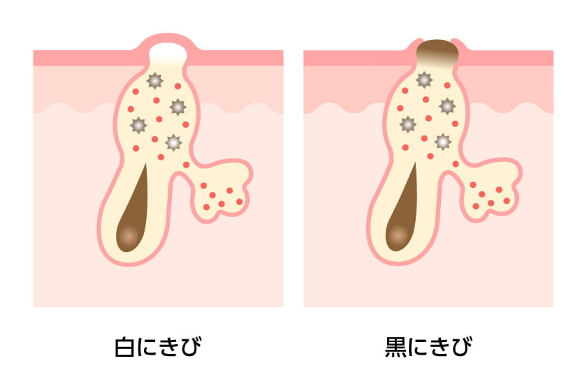 白にきび・黒にきび