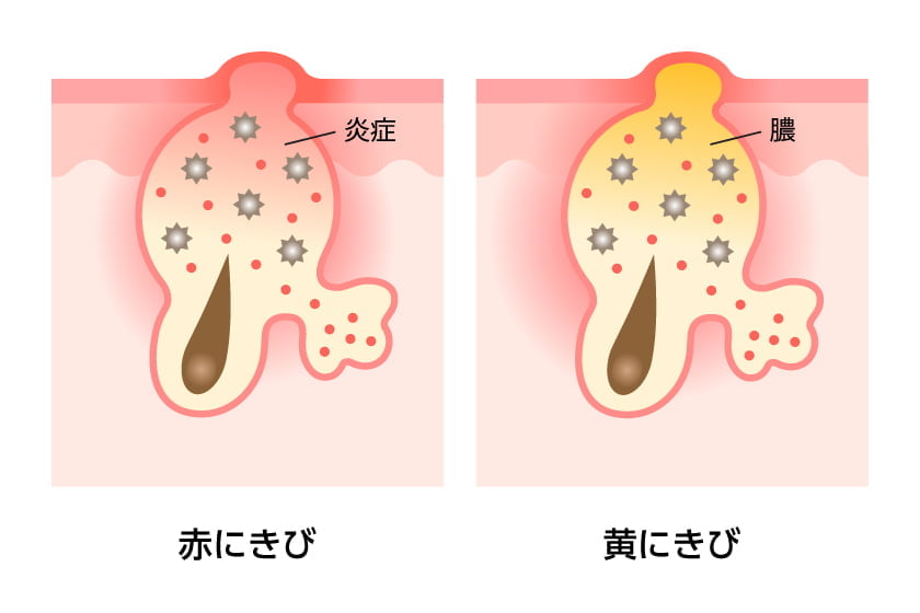 赤にきび・黄にきび