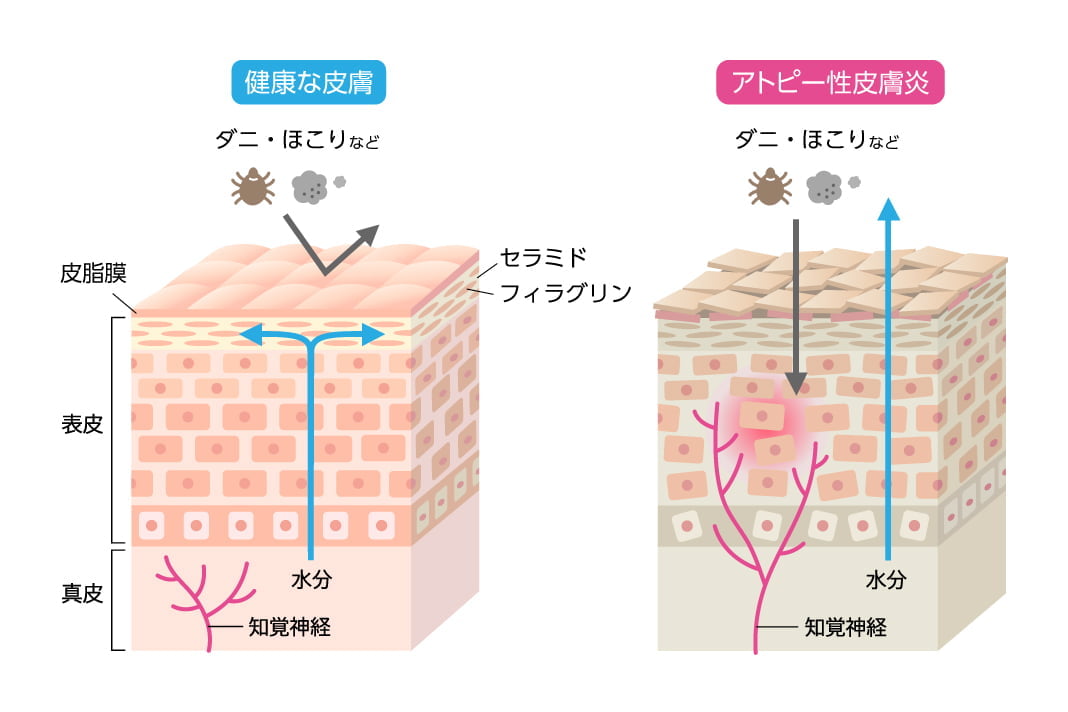 健康な皮膚とアトピー性皮膚炎