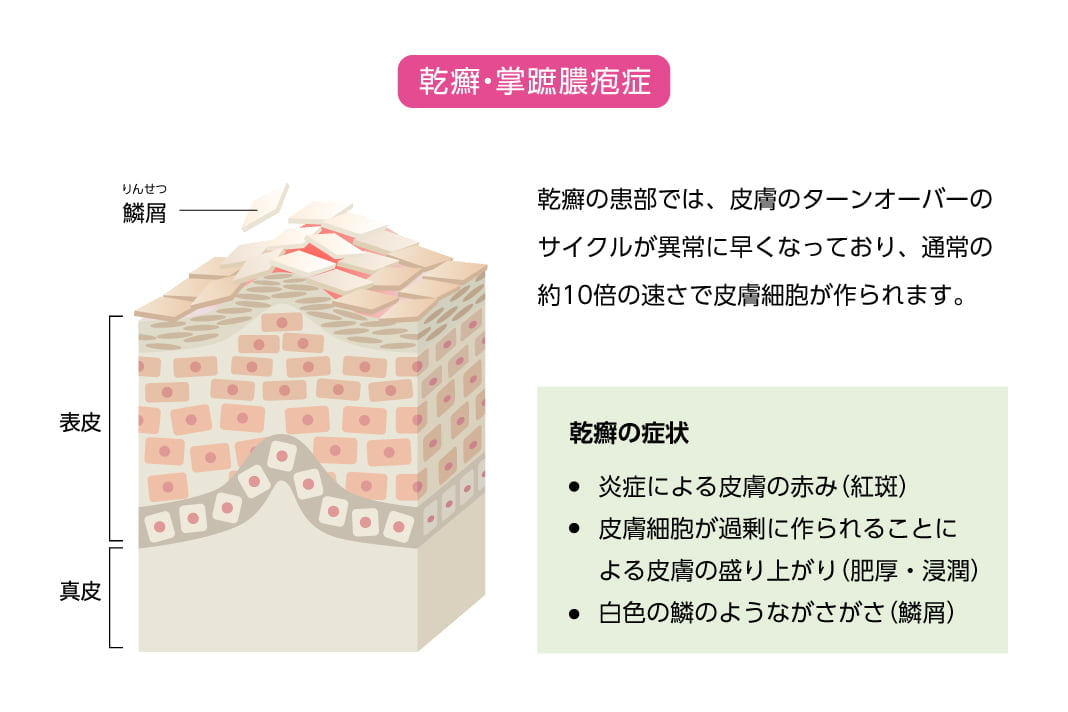 乾癬・掌蹠膿疱症/乾癬の患部では、皮膚のターンオーバーのサイクルが異常に早くなっており、通常の約10倍の速さで皮膚細胞が作られます。 乾癬の症状/炎症による皮膚の赤み(紅斑)・皮膚細胞が過剰に作られることによる皮膚の盛り上がり(肥厚・浸潤)・白色の鱗のようながさがさ(鱗屑)