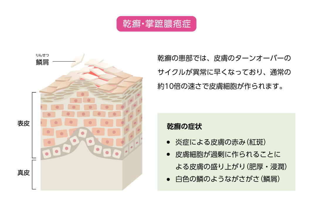 乾癬・掌蹠膿疱症／乾癬の患部では、皮膚のターンオーバーのサイクルが異常に早くなっており、通常の約10倍の速さで皮膚細胞が作られます。　乾癬の症状／炎症による皮膚の赤み(紅斑)・皮膚細胞が過剰に作られることによる皮膚の盛り上がり(肥厚・浸潤)・白色の鱗のようながさがさ(鱗屑)