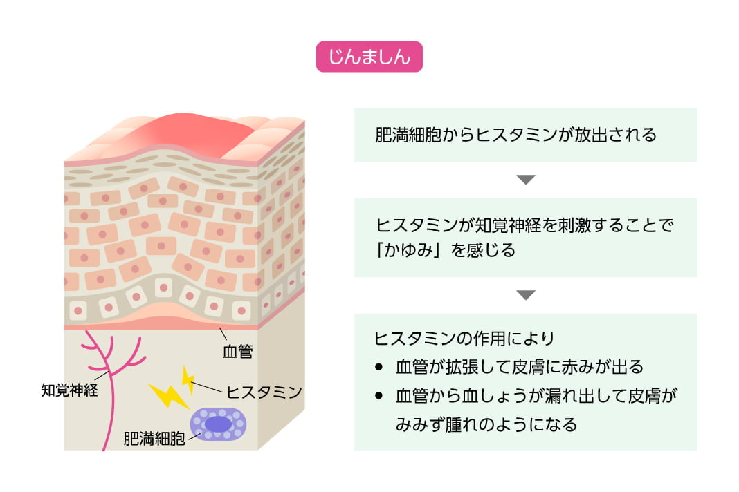 じんましん/肥満細胞からヒスタミンが放出される→ヒスタミンが知覚神経を刺激することで「かゆみ」を感じる→ヒスタミンの作用により血管が拡張して皮膚に赤みが出る、血管から血しょうが漏れ出して皮膚がみみず腫れのようになる