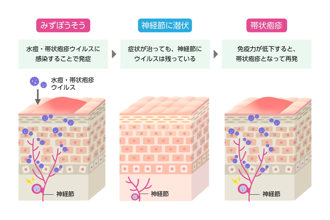 みずぼうそう（水痘・帯状疱疹ウイルスに感染することで発症）→神経節に潜伏（症状が治っても、神経節にウイルスは残っている）→帯状疱疹（免疫力が低下すると、帯状疱疹となって再発）