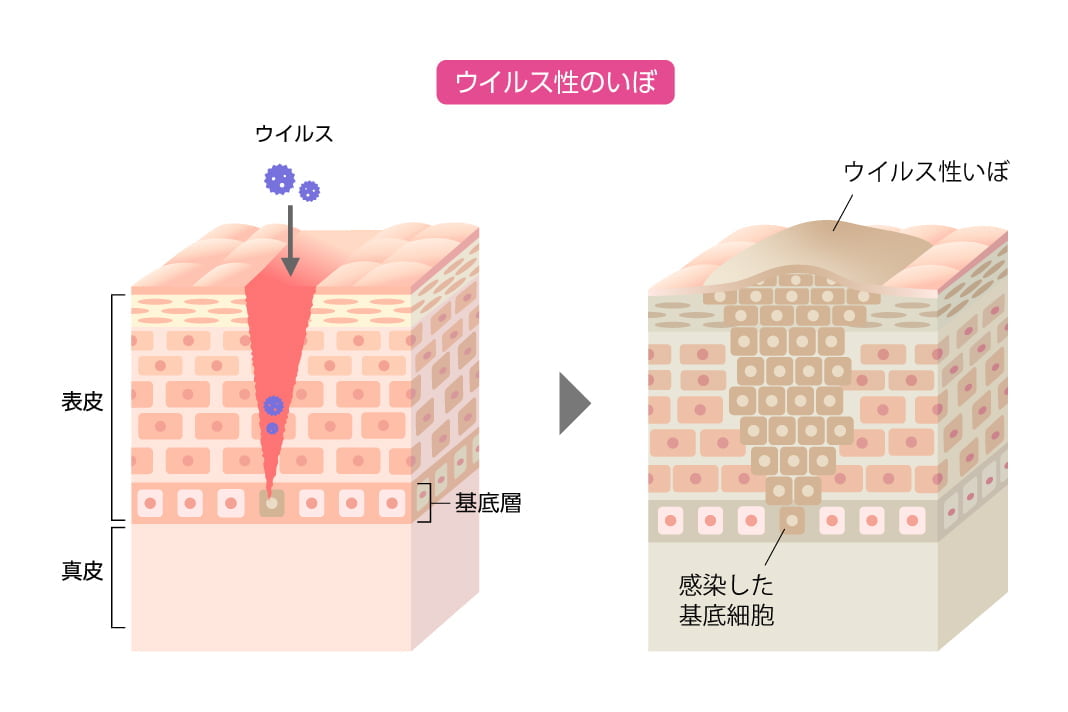 ウイルス性のいぼ