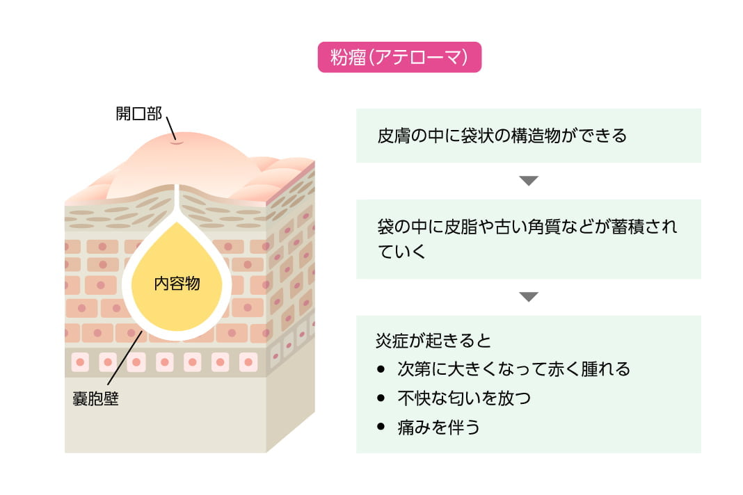 粉瘤（アテローマ）／皮膚の中に袋状の構造物ができる→袋の中に皮脂や古い角質などが蓄積されていく→炎症が起きると、次第に大きくなって赤く腫れる・不快な匂いを放つ・痛みを伴う