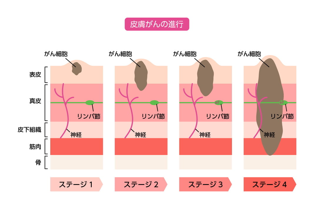 皮膚がんの進行